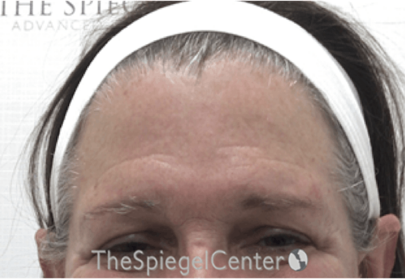 Forehead Contouring Before & After Gallery - Patient 101135 - Image 1
