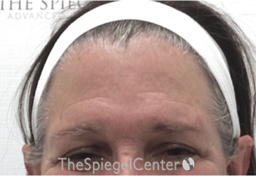 Forehead Contouring Before & After Gallery - Patient 101135 - Image 1