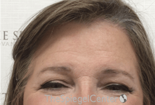 Forehead Contouring Before & After Gallery - Patient 101135 - Image 2