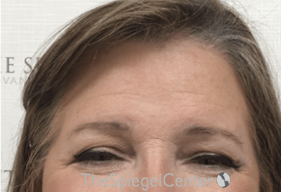 Forehead Contouring Before & After Gallery - Patient 101135 - Image 2