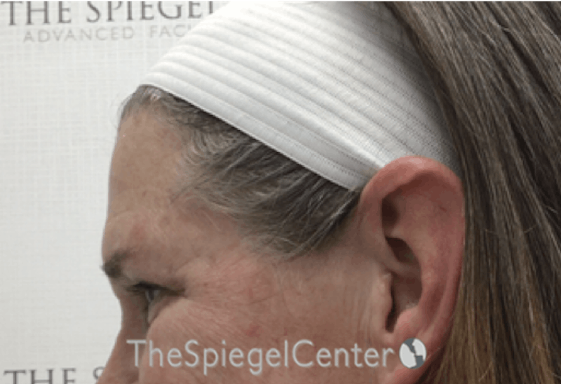 Forehead Contouring Before & After Gallery - Patient 101135 - Image 3