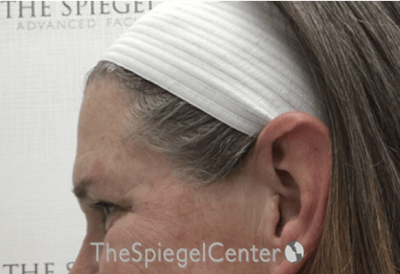 Forehead Contouring Before & After Gallery - Patient 101135 - Image 3