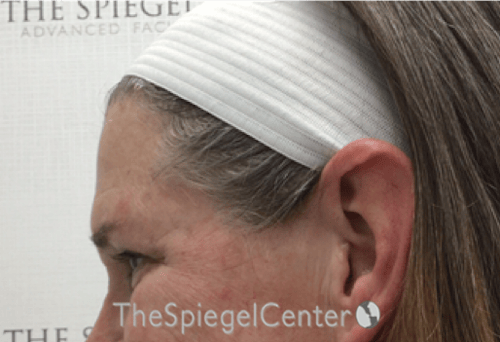 Forehead Contouring Before & After Gallery - Patient 101135 - Image 3