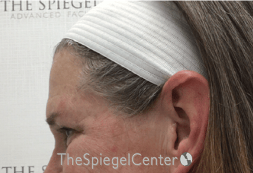 Forehead Contouring Before & After Gallery - Patient 101135 - Image 3