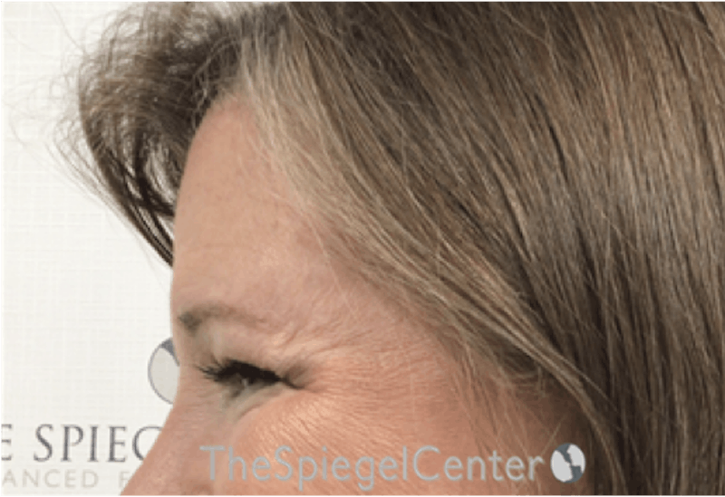 Forehead Contouring Before & After Gallery - Patient 101135 - Image 4