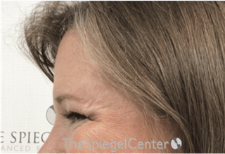 Forehead Contouring Before & After Gallery - Patient 101135 - Image 4