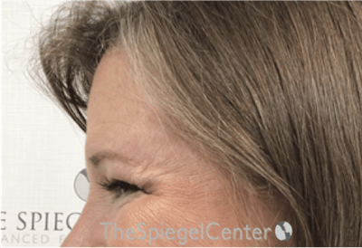 Forehead Contouring Before & After Gallery - Patient 101135 - Image 4