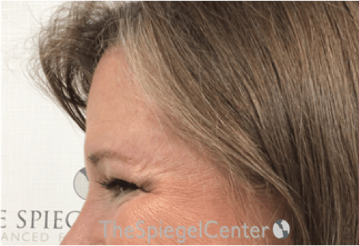 Forehead Contouring Before & After Gallery - Patient 101135 - Image 4