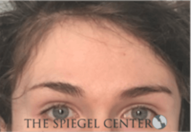 Forehead Contouring Before & After Gallery - Patient 625786 - Image 1