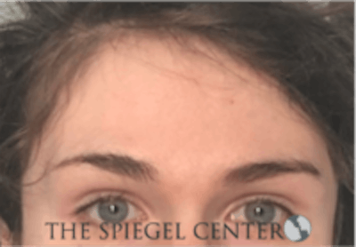 Forehead Contouring Before & After Gallery - Patient 625786 - Image 1