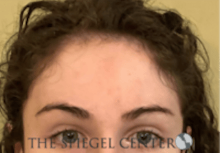 Forehead Contouring Before & After Gallery - Patient 625786 - Image 2