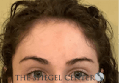Forehead Contouring Before & After Gallery - Patient 625786 - Image 2
