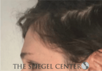Forehead Contouring Before & After Gallery - Patient 625786 - Image 3