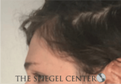 Forehead Contouring Before & After Gallery - Patient 625786 - Image 3