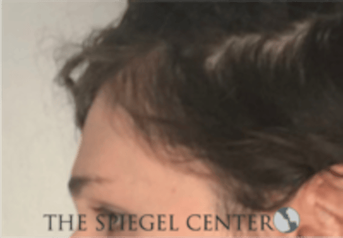 Forehead Contouring Before & After Gallery - Patient 625786 - Image 3