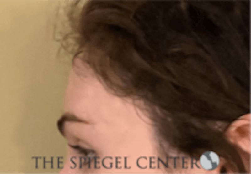 Forehead Contouring Before & After Gallery - Patient 625786 - Image 4