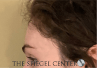 Forehead Contouring Before & After Gallery - Patient 625786 - Image 4