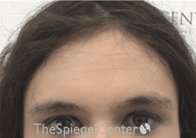Forehead Contouring Before & After Gallery - Patient 874990 - Image 1