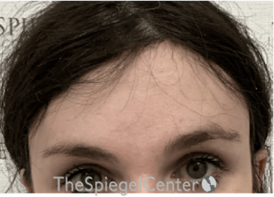 Forehead Contouring Before & After Gallery - Patient 874990 - Image 2