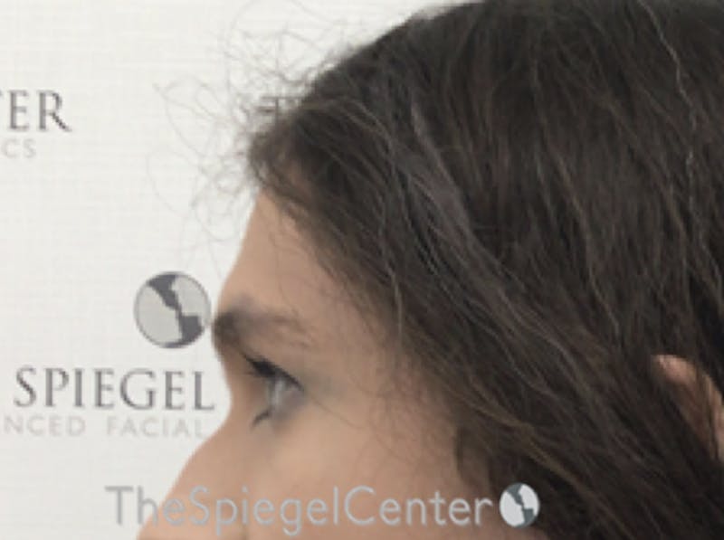 FFS Forehead Contouring Before & After Gallery - Patient 109989 - Image 3