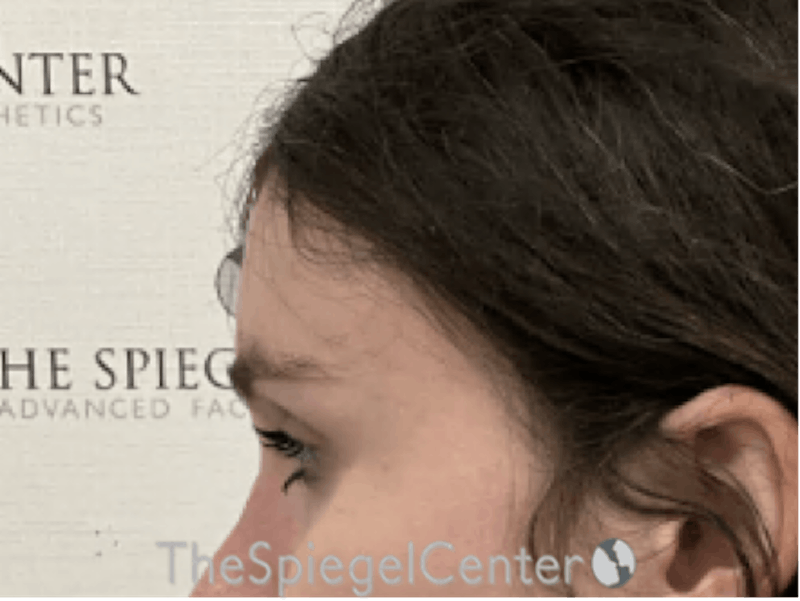 FFS Forehead Contouring Before & After Gallery - Patient 109989 - Image 4