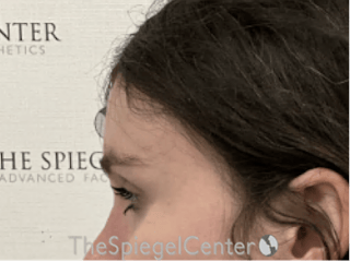 Forehead Contouring Before & After Gallery - Patient 874990 - Image 4