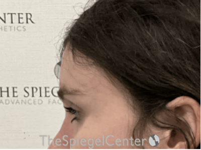 Forehead Contouring Before & After Gallery - Patient 874990 - Image 4