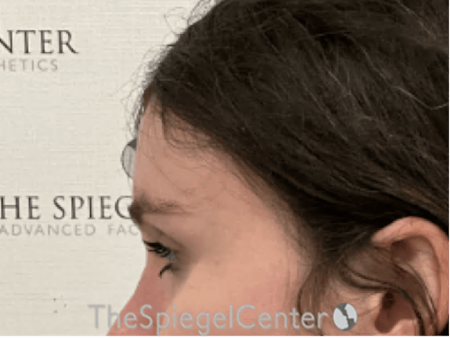 Forehead Contouring Before & After Gallery - Patient 874990 - Image 4