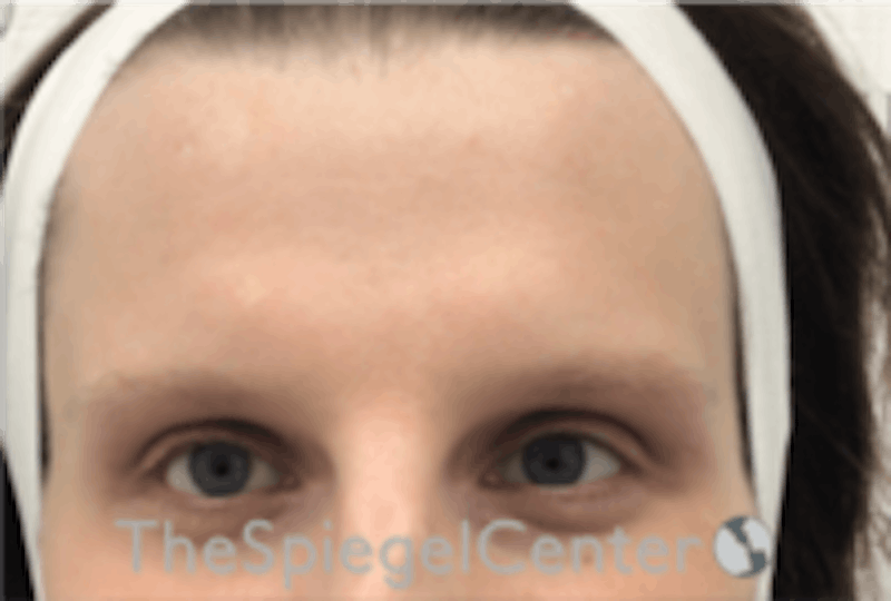Forehead Contouring Before & After Gallery - Patient 224933 - Image 1