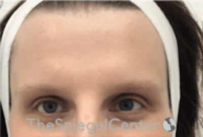 Forehead Contouring Before & After Gallery - Patient 224933 - Image 1