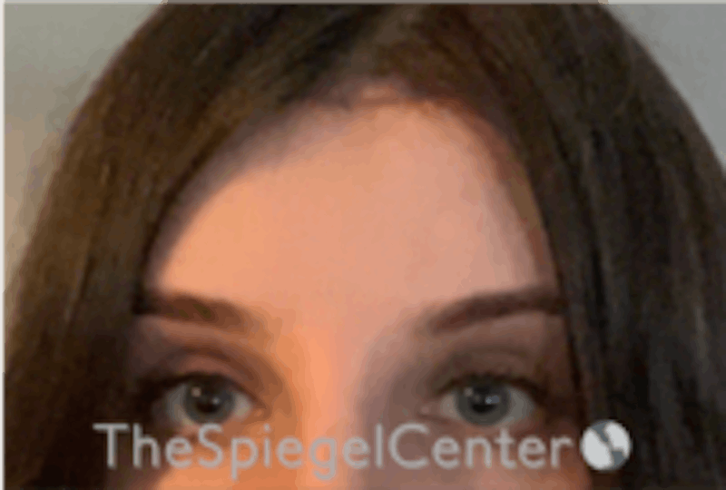 Forehead Contouring Before & After Gallery - Patient 224933 - Image 2