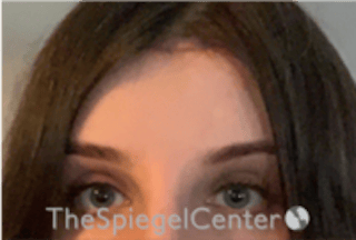 Forehead Contouring Before & After Gallery - Patient 224933 - Image 2