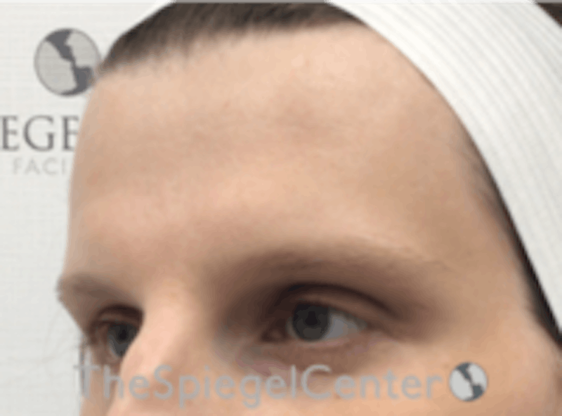 Forehead Contouring Before & After Gallery - Patient 224933 - Image 3