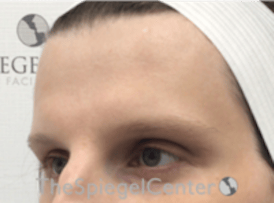 Forehead Contouring Before & After Gallery - Patient 224933 - Image 3