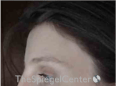 Forehead Contouring Before & After Gallery - Patient 224933 - Image 4