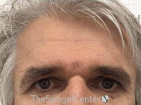 FFS Forehead Contouring Before & After Gallery - Patient 195772 - Image 1
