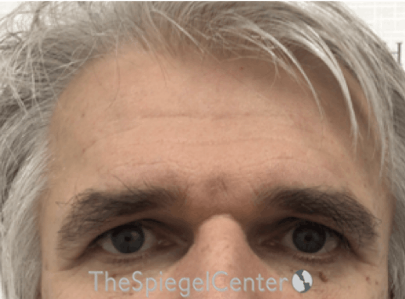 FFS Forehead Contouring Before & After Gallery - Patient 195772 - Image 1