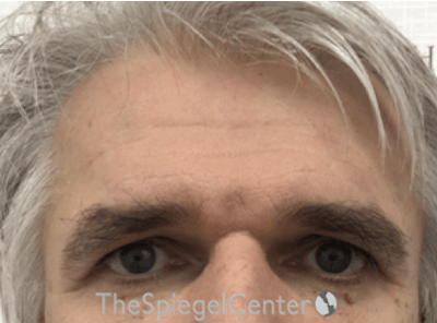 Forehead Contouring Before & After Gallery - Patient 965283 - Image 1