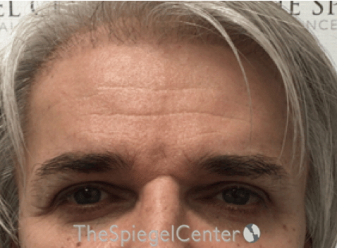 FFS Forehead Contouring Before & After Gallery - Patient 195772 - Image 2