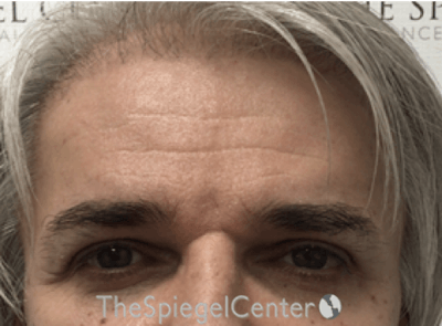 Forehead Contouring Before & After Gallery - Patient 965283 - Image 2