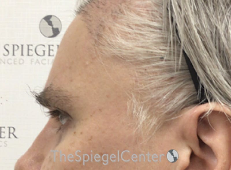 FFS Forehead Contouring Before & After Gallery - Patient 195772 - Image 4