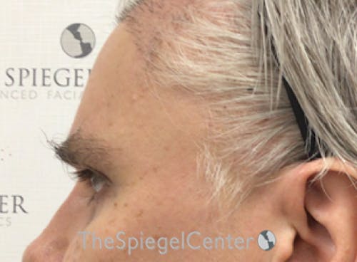 Forehead Contouring Before & After Gallery - Patient 965283 - Image 4