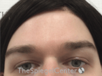 Forehead Contouring Before & After Gallery - Patient 274164 - Image 1