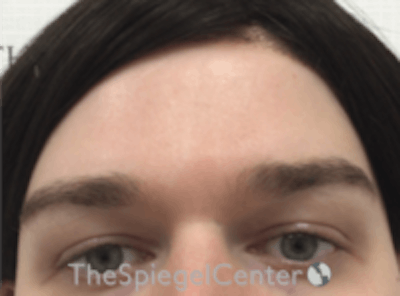 Forehead Contouring Before & After Gallery - Patient 274164 - Image 1