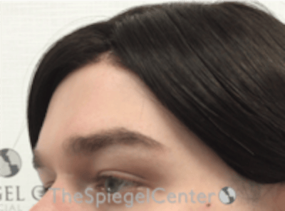 Forehead Contouring Before & After Gallery - Patient 274164 - Image 3