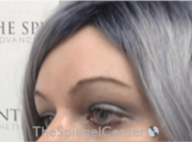 FFS Forehead Contouring Before & After Gallery - Patient 311987 - Image 4