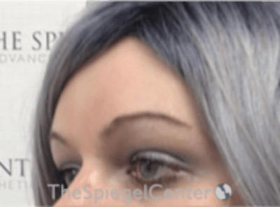 Forehead Contouring Before & After Gallery - Patient 274164 - Image 4