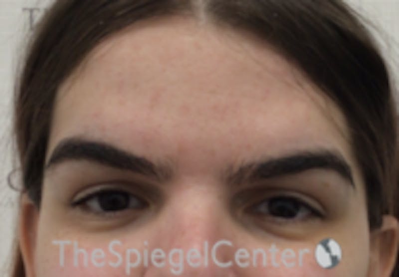 Forehead Contouring Before & After Gallery - Patient 189184 - Image 1