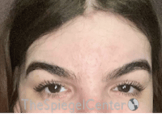 Forehead Contouring Before & After Gallery - Patient 189184 - Image 2