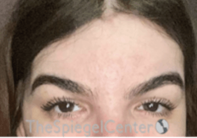 Forehead Contouring Before & After Gallery - Patient 189184 - Image 2